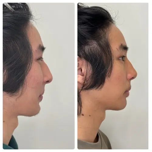 Rhinoplasty, right profile, 3 months post-op, case 16