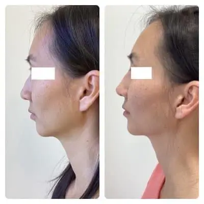 Non-surgical rhinoplasty, left profile, filler nose reshaping, case 3