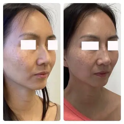 Non-surgical rhinoplasty, right oblique, filler nose reshaping, case 3