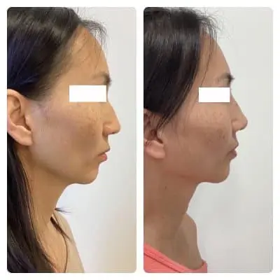 Non-surgical rhinoplasty, right profile, filler nose reshaping, case 3
