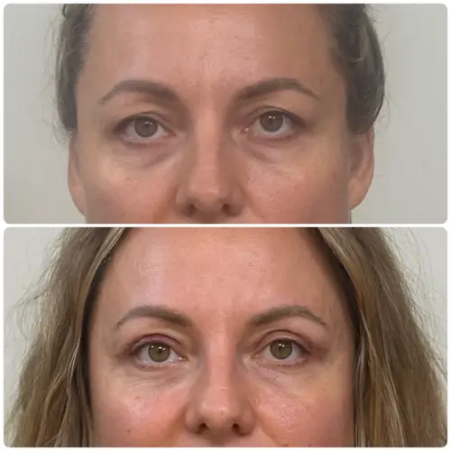 Upper blepharoplasty, front view, patient in her 40s, 1 week post-op, case 2
