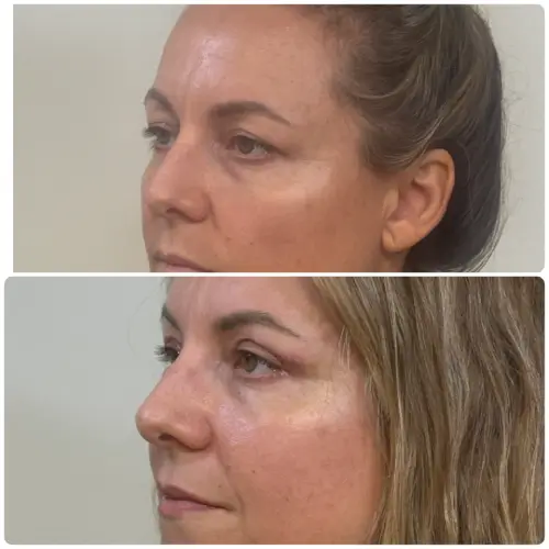 Upper blepharoplasty, left oblique, patient in her 40s, 1 week post-op, case 2