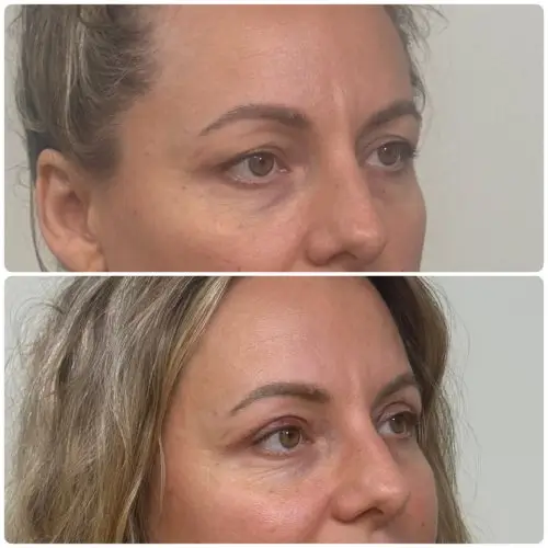 Upper blepharoplasty, right oblique, patient in her 40s, 1 week post-op, case 2
