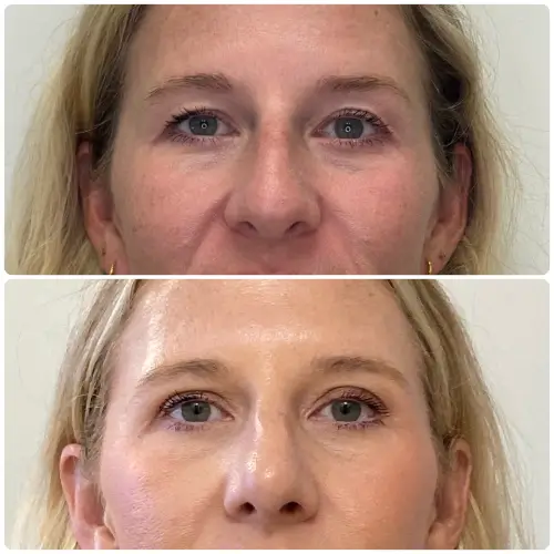 Upper blepharoplasty, front view, patient in her 40s, case 1