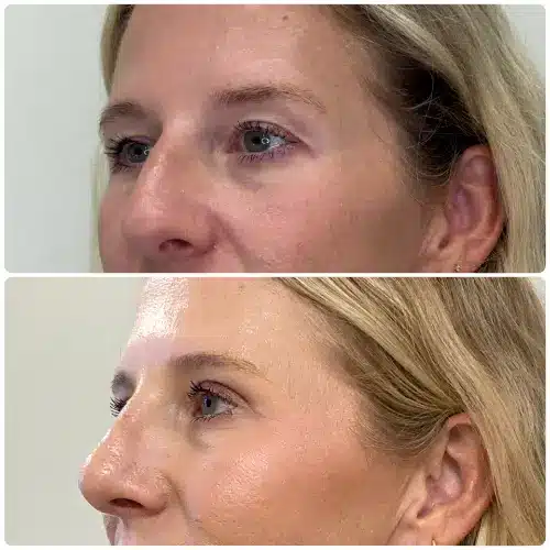 Upper blepharoplasty, left oblique, patient in her 40s, case 1