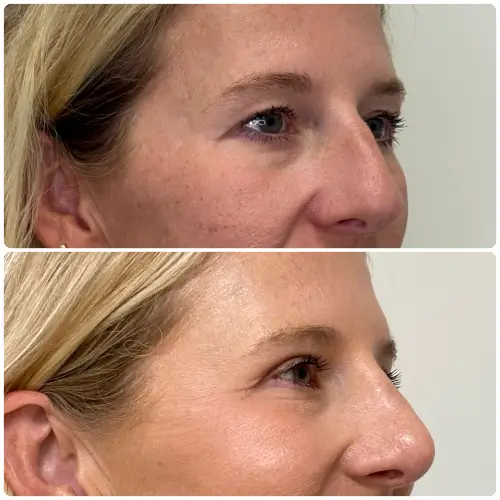 Upper blepharoplasty, right oblique, patient in her 40s, case 1