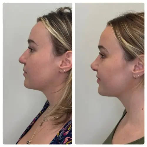 Rhinoplasty, left profile, patient in her 20s, tip elevation and profile, 6 months post-op, case 8