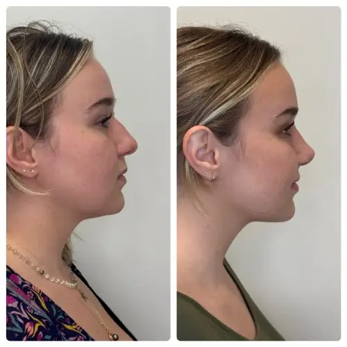 Rhinoplasty, right profile, patient in her 20s, tip elevation and profile, 6 months post-op, case 8