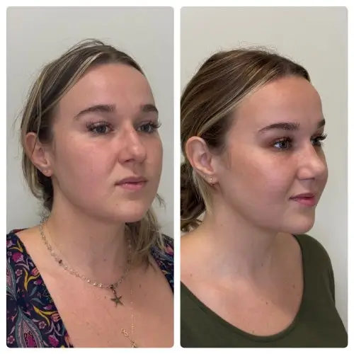 Rhinoplasty, right oblique, patient in her 20s, tip elevation and profile, 6 months post-op, case 8