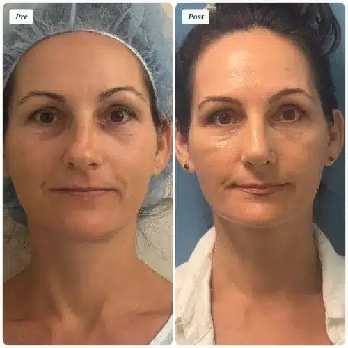Rhinoplasty, front view, patient in her 40s, function and appearance, 6 months post-op, case 3
