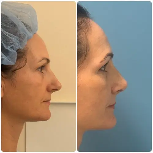 Rhinoplasty, right profile, patient in her 40s, function and appearance, 6 months post-op, case 3