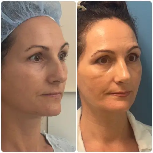 Rhinoplasty, right oblique, patient in her 40s, function and appearance, 6 months post-op, case 3
