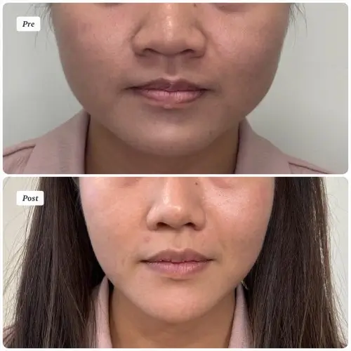 Asian augmentation rhinoplasty, front view, patient in her 20s, rib cartilage graft and alar base reduction, case 7