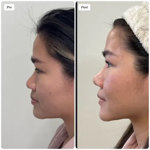 Asian augmentation rhinoplasty, left profile, patient in her 20s, rib cartilage graft and alar base reduction, case 7