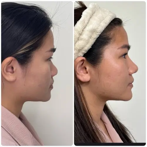 Asian augmentation rhinoplasty, right profile, patient in her 20s, rib cartilage graft and alar base reduction, case 7