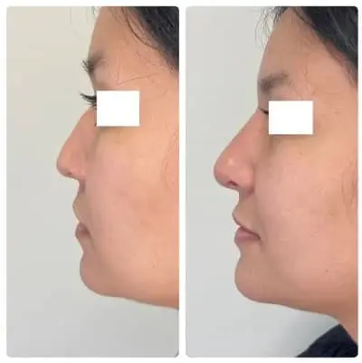 Non-surgical rhinoplasty, left profile, filler nose reshaping, case 4