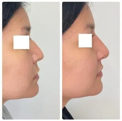 Non-surgical rhinoplasty, right profile, filler nose reshaping, case 4