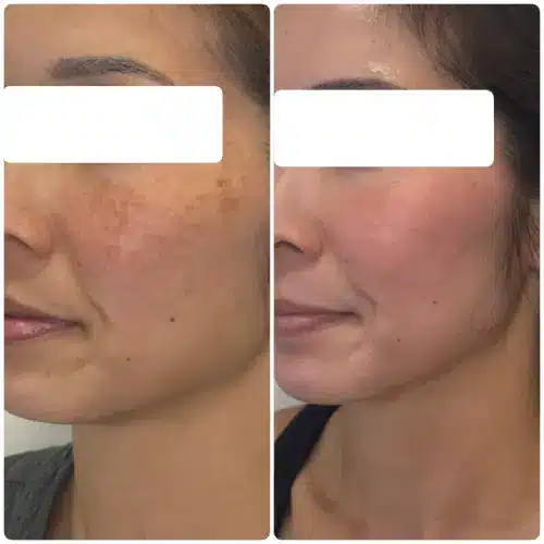 Hyperpigmentation treatment, left oblique, patient in her 40s, case 11