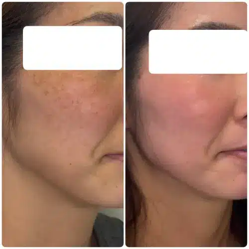 Hyperpigmentation treatment, right oblique, patient in her 40s, case 11