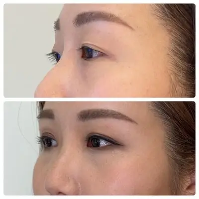 Asian blepharoplasty double eyelid surgery, left oblique, patient in her 30s, case 1