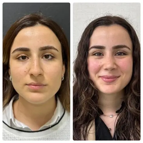 Rhinoplasty, front view, 1 year post-op, case 17