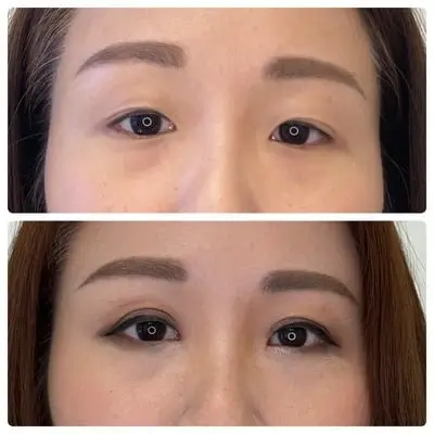 Asian blepharoplasty double eyelid surgery, front view, patient in her 30s, case 1