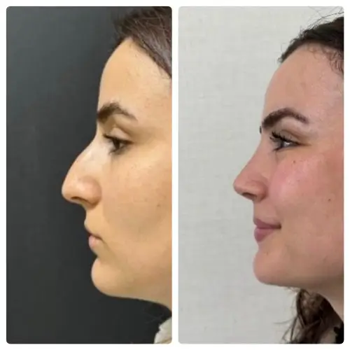 Rhinoplasty, left profile, 1 year post-op, case 17