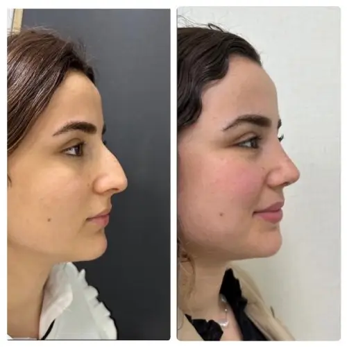 Rhinoplasty, right profile, 1 year post-op, case 17