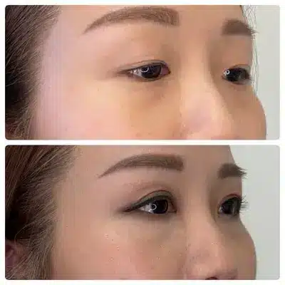 Asian blepharoplasty double eyelid surgery, right oblique, patient in her 30s, case 1