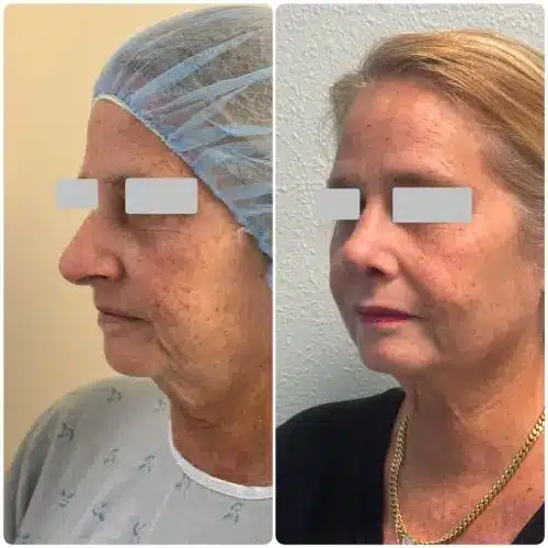 Rhinoplasty, left oblique, 6 months post-op, case 18