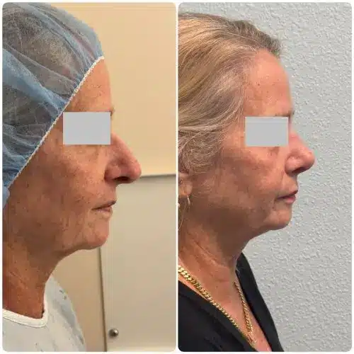 Rhinoplasty, right profile, 6 months post-op, case 18