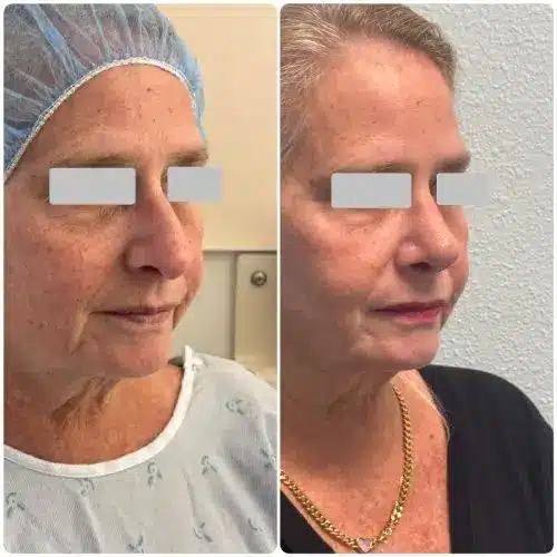 Rhinoplasty, right oblique, 6 months post-op, case 18