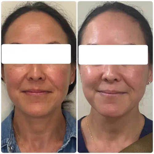 Melasma treatment, front view, pigmentation protocol with medical-grade skincare and in-office treatment, case 3