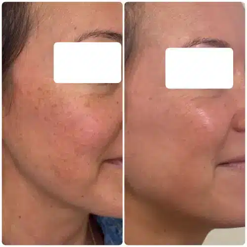 Melasma treatment, close-up, right profile, pigmentation protocol with medical-grade skincare and in-office treatment, case 3