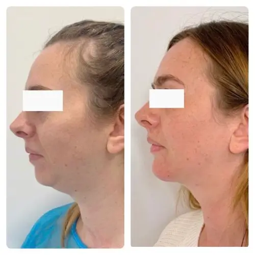 Neck liposuction, left profile, 6 months post-op, case 2