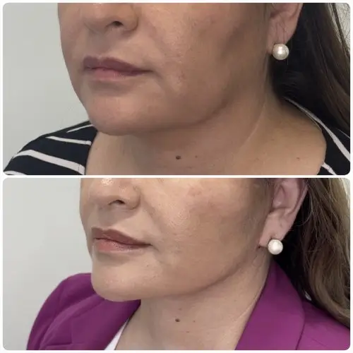 Deep plane facelift and neck lift, left oblique, patient in her 50s, 1 year post-op, case 6