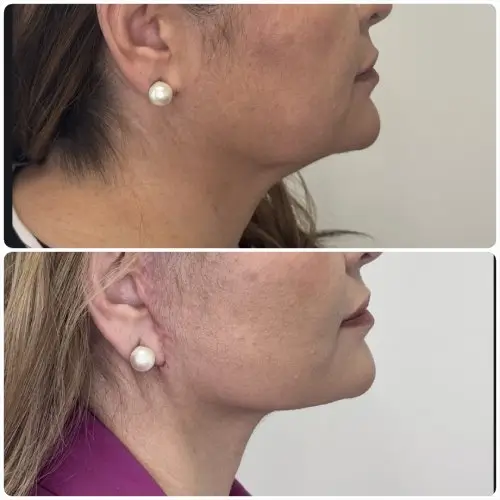 Deep plane facelift and neck lift, right profile, patient in her 50s, 1 year post-op, case 6
