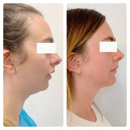 Neck liposuction, right profile, 6 months post-op, case 2