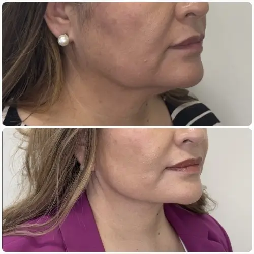 Deep plane facelift and neck lift, right oblique, patient in her 50s, 1 year post-op, case 6