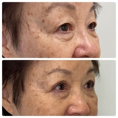 Asian blepharoplasty double eyelid surgery, right oblique, patient in her 70s, case 5