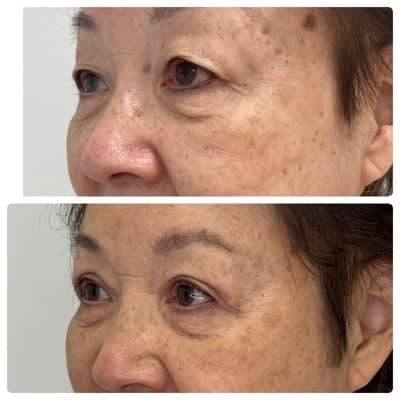 Asian blepharoplasty double eyelid surgery, left oblique, patient in her 70s, case 5