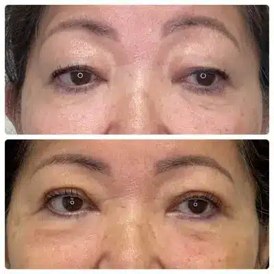 Asian blepharoplasty double eyelid surgery, front view, patient in her 60s, case 2