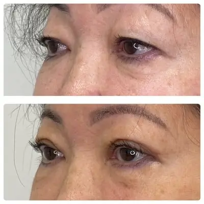 Asian blepharoplasty double eyelid surgery, left oblique, patient in her 60s, case 2