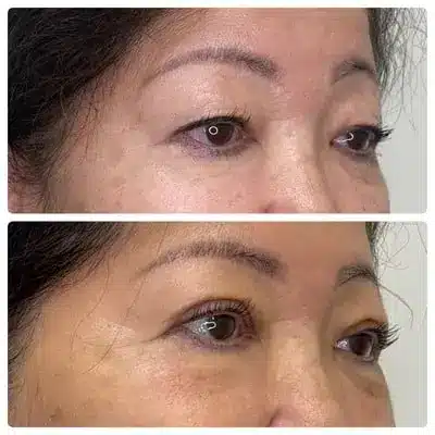 Asian blepharoplasty double eyelid surgery, right oblique, patient in her 60s, case 2