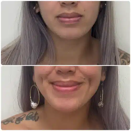 Dimple creation (dimpleplasty), front view, patient in her 20s, case 1