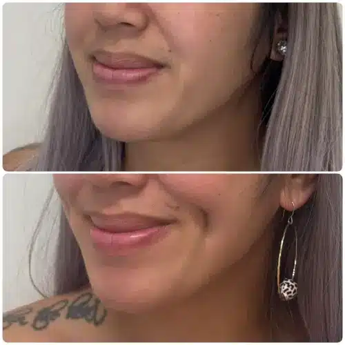 Dimple creation (dimpleplasty), left oblique, patient in her 20s, case 1