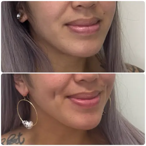 Dimple creation (dimpleplasty), right oblique, patient in her 20s, case 1