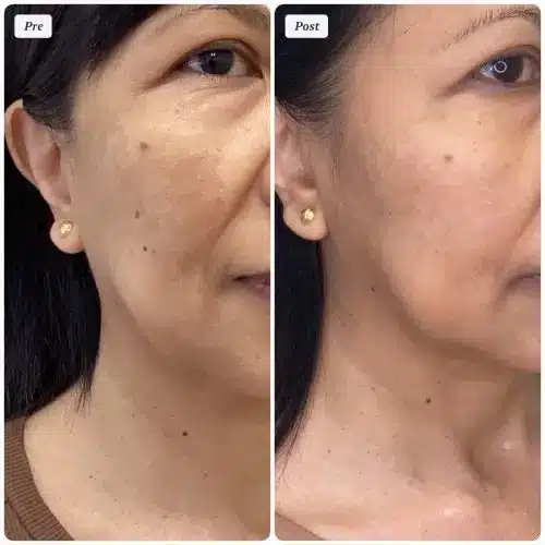 Melasma treatment, right oblique, pigmentation protocol with medical-grade skincare and in-office treatment, case 4