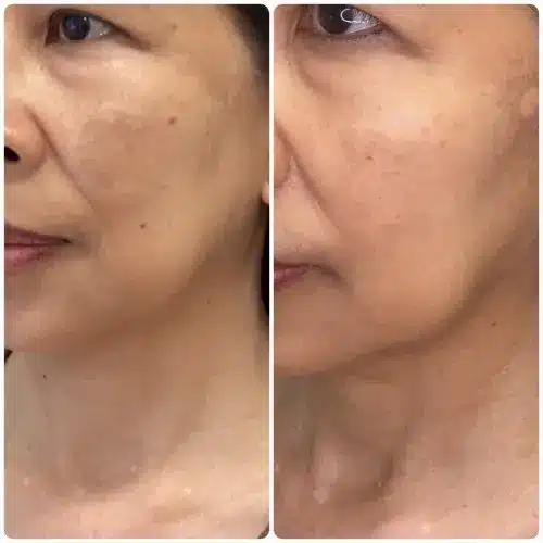 Melasma treatment, left oblique, pigmentation protocol with medical-grade skincare and in-office treatment, case 4