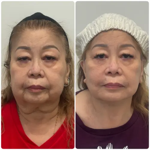 Deep plane facelift and neck lift, front view, patient in her 60s, 3 months post-op, case 4